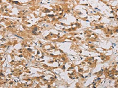 The image on the left is immunohistochemistry of paraffin-embedded Human thyroid cancer tissue using CSB-PA794556(DDIT4 Antibody) at dilution 1/20, on the right is treated with fusion protein. (Original magnification: ×200)