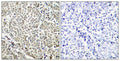 Immunohistochemical analysis of paraffin-embedded human breast carcinoma tissue using NFkB-p65(Phospho-Ser529) Antibody(left) or the same antibody preincubated with blocking peptide(right).
