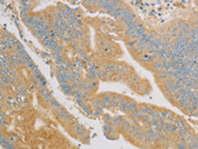The image on the left is immunohistochemistry of paraffin-embedded Human colon cancer tissue using CSB-PA795042(KLF17 Antibody) at dilution 1/30, on the right is treated with fusion protein. (Original magnification: ×200)