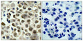 Immunohistochemical analysis of paraffin-embedded human lung carcinoma tissue using HDAC8(Phospho-Ser39) Antibody(left) or the same antibody preincubated with blocking peptide(right).