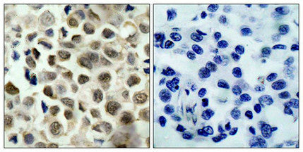 Immunohistochemical analysis of paraffin-embedded human lung carcinoma tissue using HDAC8(Phospho-Ser39) Antibody(left) or the same antibody preincubated with blocking peptide(right).
