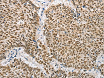 The image on the left is immunohistochemistry of paraffin-embedded Human lung cancer tissue using CSB-PA795084(DNAJB1 Antibody) at dilution 1/20, on the right is treated with fusion protein. (Original magnification: ×200)