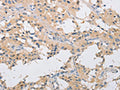 The image on the left is immunohistochemistry of paraffin-embedded Human thyroid cancer tissue using CSB-PA795347(IKBKG Antibody) at dilution 1/40, on the right is treated with fusion protein. (Original magnification: ×200)
