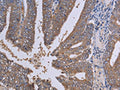 The image on the left is immunohistochemistry of paraffin-embedded Human colon cancer tissue using CSB-PA795414(LIMS1 Antibody) at dilution 1/30, on the right is treated with fusion protein. (Original magnification: ×200)