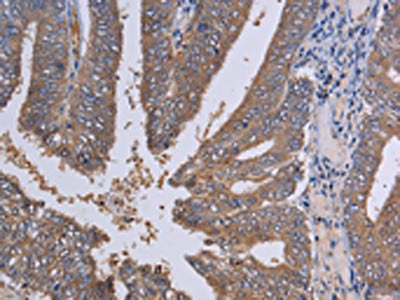 The image on the left is immunohistochemistry of paraffin-embedded Human colon cancer tissue using CSB-PA795414(LIMS1 Antibody) at dilution 1/30, on the right is treated with fusion protein. (Original magnification: ×200)
