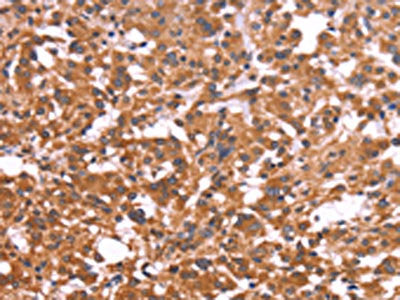 The image on the left is immunohistochemistry of paraffin-embedded Human thyroid cancer tissue using CSB-PA795553(CRISP3 Antibody) at dilution 1/50, on the right is treated with fusion protein. (Original magnification: ×200)