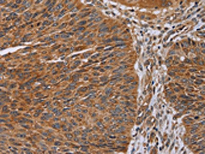 The image on the left is immunohistochemistry of paraffin-embedded Human lung cancer tissue using CSB-PA795585(NDUFA8 Antibody) at dilution 1/30, on the right is treated with synthetic peptide. (Original magnification: ×200)