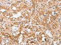 The image on the left is immunohistochemistry of paraffin-embedded Human thyroid cancer tissue using CSB-PA795707(PLA2G4A Antibody) at dilution 1/40, on the right is treated with fusion protein. (Original magnification: ×200)