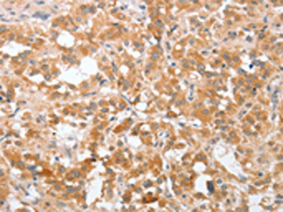 The image on the left is immunohistochemistry of paraffin-embedded Human thyroid cancer tissue using CSB-PA795707(PLA2G4A Antibody) at dilution 1/40, on the right is treated with fusion protein. (Original magnification: ×200)