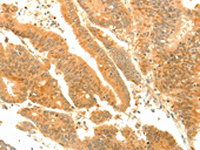 The image on the left is immunohistochemistry of paraffin-embedded Human colon cancer tissue using CSB-PA795855(SOCS6 Antibody) at dilution 1/35, on the right is treated with fusion protein. (Original magnification: ×200)