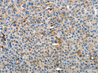 The image on the left is immunohistochemistry of paraffin-embedded Human liver cancer tissue using CSB-PA795997(APOH Antibody) at dilution 1/15, on the right is treated with fusion protein. (Original magnification: ×200)
