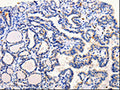 The image on the left is immunohistochemistry of paraffin-embedded Human thyroid cancer tissue using CSB-PA796026(ARL6 Antibody) at dilution 1/25, on the right is treated with fusion protein. (Original magnification: ×200)