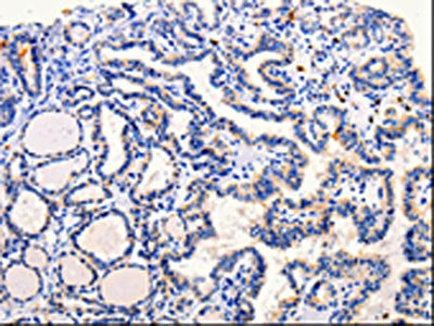 The image on the left is immunohistochemistry of paraffin-embedded Human thyroid cancer tissue using CSB-PA796026(ARL6 Antibody) at dilution 1/25, on the right is treated with fusion protein. (Original magnification: ×200)