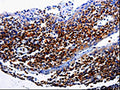 The image on the left is immunohistochemistry of paraffin-embedded Human tonsil tissue using CSB-PA796040(IL31RA Antibody) at dilution 1/40, on the right is treated with fusion protein. (Original magnification: ×200)