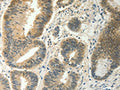 The image on the left is immunohistochemistry of paraffin-embedded Human colon cancer tissue using CSB-PA796488(SOCS5 Antibody) at dilution 1/35, on the right is treated with fusion protein. (Original magnification: ×200)