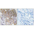 Immunohistochemistry analysis of paraffin-embedded human breast carcinoma tissue, using CCT6A antibody.
