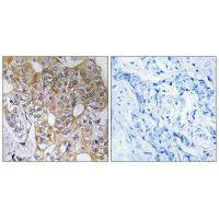 Immunohistochemistry analysis of paraffin-embedded human breast carcinoma tissue, using CCT6A antibody.