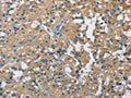 The image on the left is immunohistochemistry of paraffin-embedded Human thyroid cancer tissue using CSB-PA796667(CAB39L Antibody) at dilution 1/40, on the right is treated with fusion protein. (Original magnification: ×200)