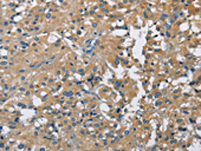 The image on the left is immunohistochemistry of paraffin-embedded Human thyroid cancer tissue using CSB-PA796667(CAB39L Antibody) at dilution 1/40, on the right is treated with fusion protein. (Original magnification: ×200)