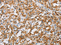 The image on the left is immunohistochemistry of paraffin-embedded Human thyroid cancer tissue using CSB-PA796730(BDH1 Antibody) at dilution 1/60, on the right is treated with fusion protein. (Original magnification: ×200)
