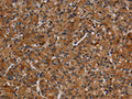 The image on the left is immunohistochemistry of paraffin-embedded Human prostate cancer tissue using CSB-PA796774(MMP9 Antibody) at dilution 1/20, on the right is treated with synthetic peptide. (Original magnification: ×200)