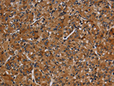 The image on the left is immunohistochemistry of paraffin-embedded Human prostate cancer tissue using CSB-PA796774(MMP9 Antibody) at dilution 1/20, on the right is treated with synthetic peptide. (Original magnification: ×200)