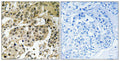 Immunohistochemical analysis of paraffin-embedded human breast carcinoma tissue using HP1α (Phospho-Ser92) antibody (left)or the same antibody preincubated with blocking peptide (right).