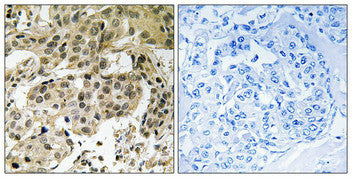 Immunohistochemical analysis of paraffin-embedded human breast carcinoma tissue using HP1α (Phospho-Ser92) antibody (left)or the same antibody preincubated with blocking peptide (right).