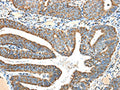 The image on the left is immunohistochemistry of paraffin-embedded Human colon cancer tissue using CSB-PA796983(NDUFA5 Antibody) at dilution 1/40, on the right is treated with fusion protein. (Original magnification: ×200)
