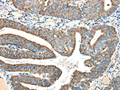 The image on the left is immunohistochemistry of paraffin-embedded Human colon cancer tissue using CSB-PA796983(NDUFA5 Antibody) at dilution 1/40, on the right is treated with fusion protein. (Original magnification: ×200)