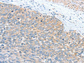 The image is immunohistochemistry of paraffin-embedded Human cervical cancer tissue using CSB-PA796998(WNT3A Antibody) at dilution 1/40. (Original magnification: ×200)