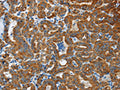The image on the left is immunohistochemistry of paraffin-embedded Human thyroid cancer tissue using CSB-PA797254(FLCN Antibody) at dilution 1/40, on the right is treated with fusion protein. (Original magnification: ×200)