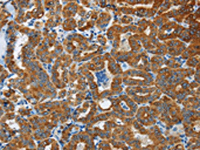 The image on the left is immunohistochemistry of paraffin-embedded Human thyroid cancer tissue using CSB-PA797254(FLCN Antibody) at dilution 1/40, on the right is treated with fusion protein. (Original magnification: ×200)