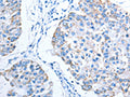 The image on the left is immunohistochemistry of paraffin-embedded Human breast cancer tissue using CSB-PA797270(ALAS1 Antibody) at dilution 1/15, on the right is treated with fusion protein. (Original magnification: ×200)