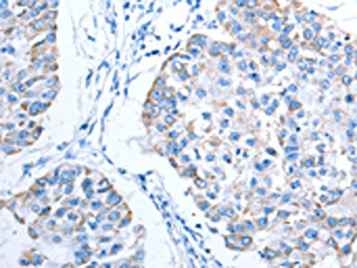The image on the left is immunohistochemistry of paraffin-embedded Human breast cancer tissue using CSB-PA797270(ALAS1 Antibody) at dilution 1/15, on the right is treated with fusion protein. (Original magnification: ×200)