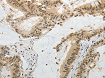 The image on the left is immunohistochemistry of paraffin-embedded Human colon cancer tissue using CSB-PA797342(MGEA5 Antibody) at dilution 1/20, on the right is treated with fusion protein. (Original magnification: ×200)