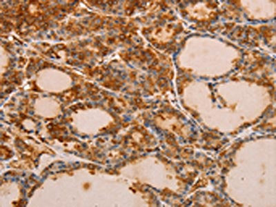 The image on the left is immunohistochemistry of paraffin-embedded Human thyroid cancer tissue using CSB-PA797351(PIK3R1 Antibody) at dilution 1/30, on the right is treated with fusion protein. (Original magnification: ×200)