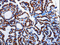 The image on the left is immunohistochemistry of paraffin-embedded Human thyroid cancer tissue using CSB-PA797497(ARL6 Antibody) at dilution 1/10, on the right is treated with fusion protein. (Original magnification: ×200)