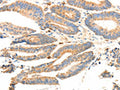 The image on the left is immunohistochemistry of paraffin-embedded Human colon cancer tissue using CSB-PA797558(PRDX3 Antibody) at dilution 1/20, on the right is treated with fusion protein. (Original magnification: ×200)