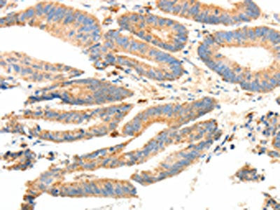 The image on the left is immunohistochemistry of paraffin-embedded Human colon cancer tissue using CSB-PA797558(PRDX3 Antibody) at dilution 1/20, on the right is treated with fusion protein. (Original magnification: ×200)