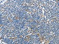 The image on the left is immunohistochemistry of paraffin-embedded Human lymphoma tissue using CSB-PA797994(PIK3R2 Antibody) at dilution 1/70, on the right is treated with synthetic peptide. (Original magnification: ×200)