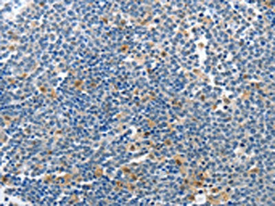 The image on the left is immunohistochemistry of paraffin-embedded Human lymphoma tissue using CSB-PA797994(PIK3R2 Antibody) at dilution 1/70, on the right is treated with synthetic peptide. (Original magnification: ×200)