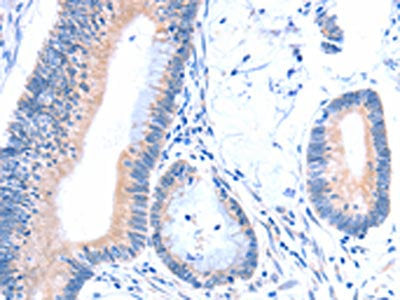 The image on the left is immunohistochemistry of paraffin-embedded Human colon cancer tissue using CSB-PA798115(ACAD8 Antibody) at dilution 1/15, on the right is treated with fusion protein. (Original magnification: ×200)