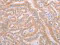The image on the left is immunohistochemistry of paraffin-embedded Human thyroid cancer tissue using CSB-PA798156(ADAMTS10 Antibody) at dilution 1/20, on the right is treated with synthetic peptide. (Original magnification: ×200)