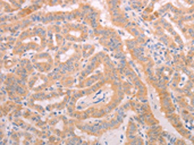 The image on the left is immunohistochemistry of paraffin-embedded Human thyroid cancer tissue using CSB-PA798156(ADAMTS10 Antibody) at dilution 1/20, on the right is treated with synthetic peptide. (Original magnification: ×200)