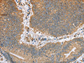 The image on the left is immunohistochemistry of paraffin-embedded Human colon cancer tissue using CSB-PA798312(CANX Antibody) at dilution 1/50, on the right is treated with fusion protein. (Original magnification: ×200)