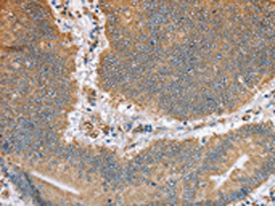 The image on the left is immunohistochemistry of paraffin-embedded Human colon cancer tissue using CSB-PA798312(CANX Antibody) at dilution 1/50, on the right is treated with fusion protein. (Original magnification: ×200)