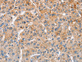 The image on the left is immunohistochemistry of paraffin-embedded Human liver cancer tissue using CSB-PA798700(MTMR4 Antibody) at dilution 1/25, on the right is treated with fusion protein. (Original magnification: ×200)