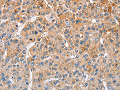 The image on the left is immunohistochemistry of paraffin-embedded Human liver cancer tissue using CSB-PA798700(MTMR4 Antibody) at dilution 1/25, on the right is treated with fusion protein. (Original magnification: ×200)