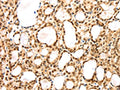 The image on the left is immunohistochemistry of paraffin-embedded Human thyroid cancer tissue using CSB-PA798773(AGPAT9 Antibody) at dilution 1/25, on the right is treated with synthetic peptide. (Original magnification: ×200)